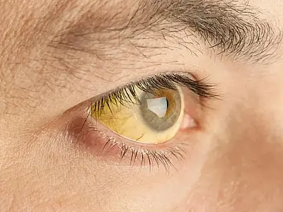 Febre amarela pode apresentar olhos e pele amarelados em seres humanos.